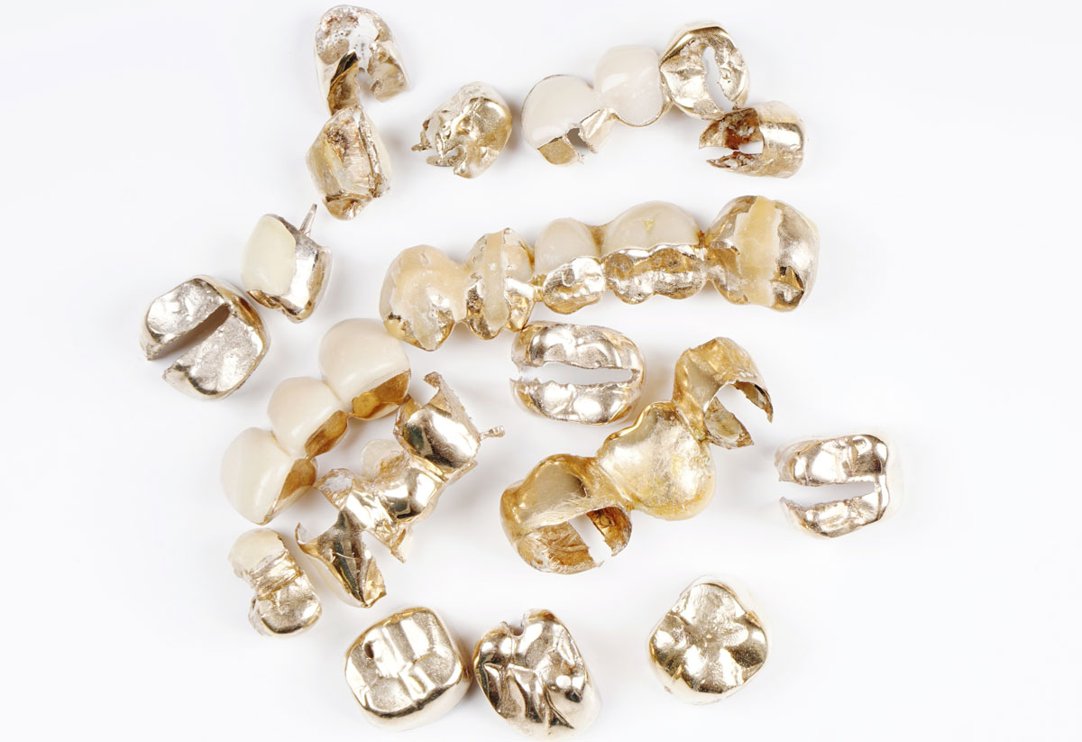 The-Use-of-Precious-Metals-in-Dentistry